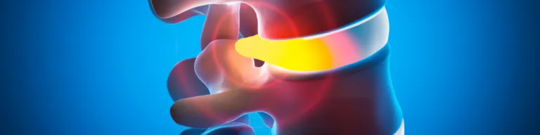 Utilização de células estaminais do cordão umbilical no tratamento de doença degenerativa do disco intervertebral